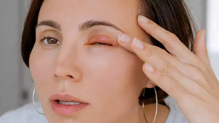 Aşırı dökülme hastalık habercisi olabilir! Gözdeki kızarıklık ve kaşıntıya dikkat